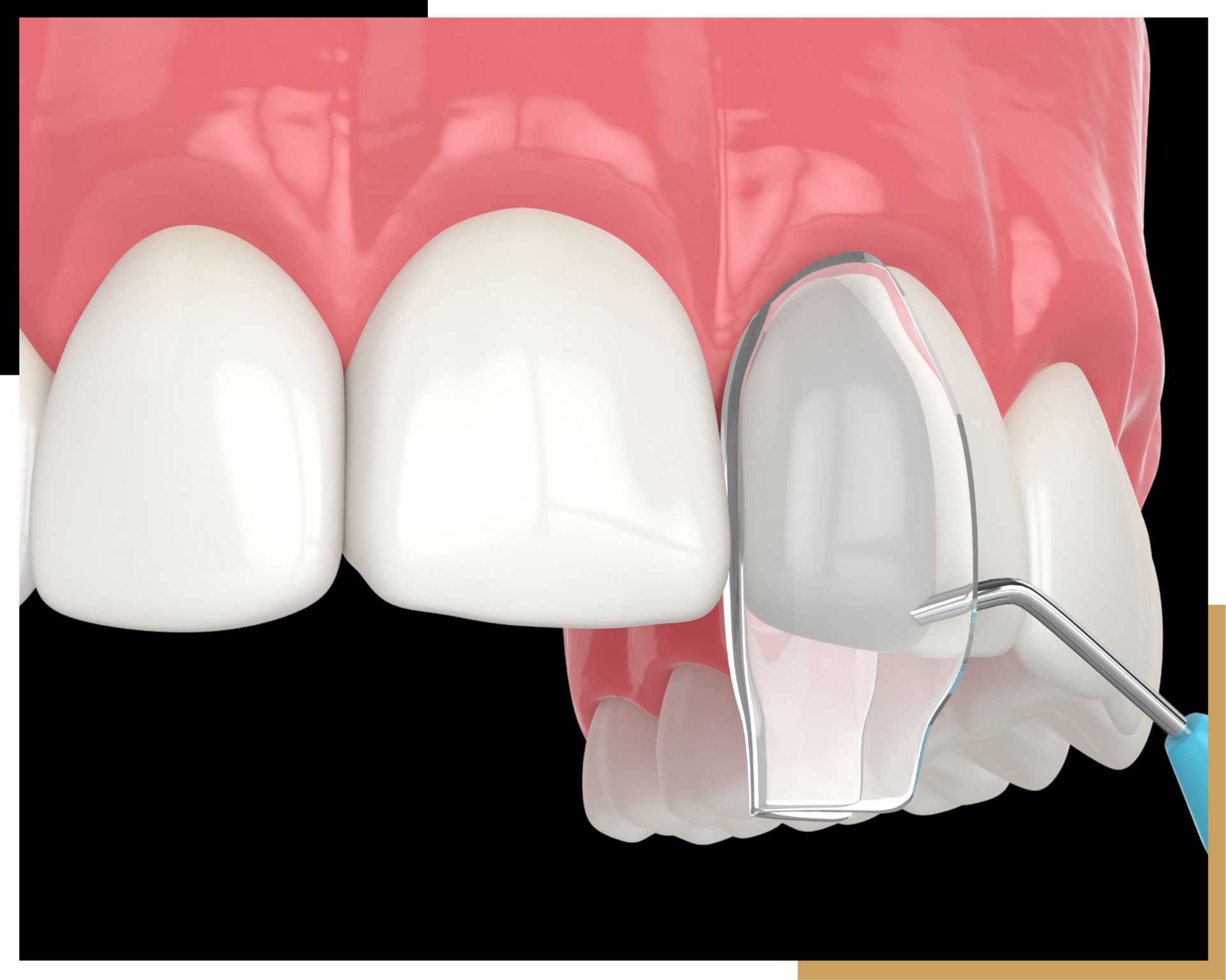 Custom Smile Design Services in Jacksonville | Cre8 Smile Studio